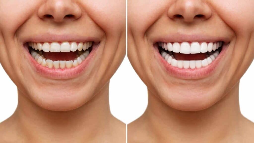 Contact Aspire White for teeth whitening services – Get in touch with Chesterfield today