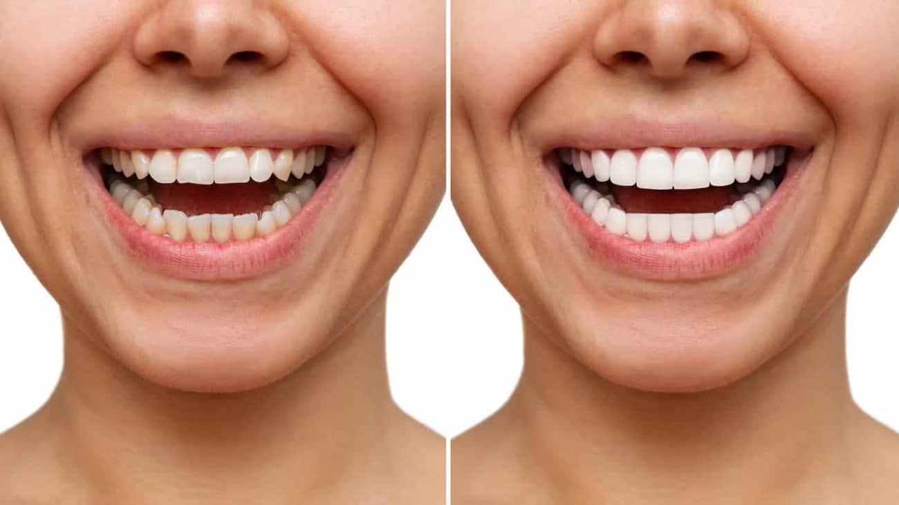 Contact Aspire White for teeth whitening services – Get in touch with Chesterfield today