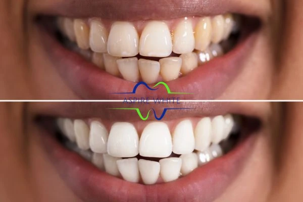 Aspire White customer before and after Chesterfield results.