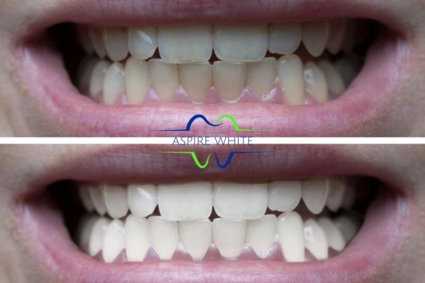 1 hour laser teeth whitening before and after results Chesterfield