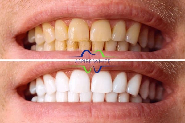 Get noticeable whiter smile in just one hour! Book your teeth whitening treatment Chesterfield today!