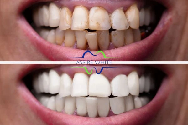 Before and after results of laser teeth whitening Chesterfield Book in online today!