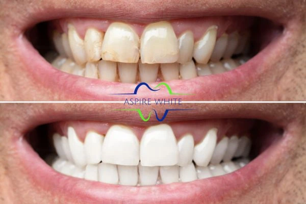 Achieve a radiant smile with professional laser teeth whitening Chesterfield